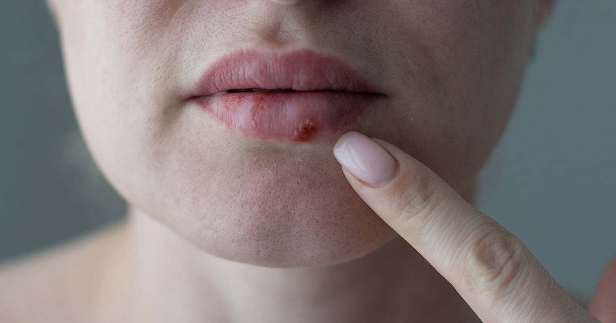 Un paso adelante contra el herpes que no se rinde: la FDA aprobó el primer antiviral oral nuevo en casi 30 años